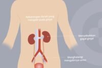 Meski berpotensi fatal, gagal ginjal akut tidak selalu permanen